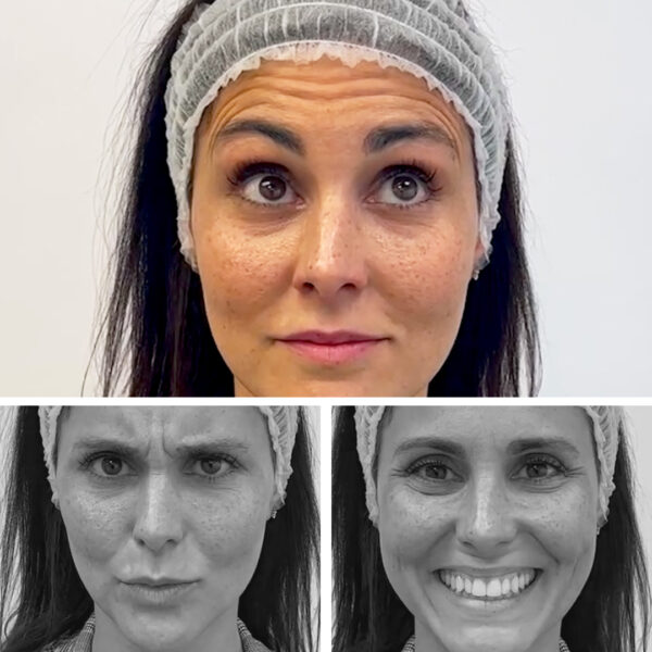 BYE BYE ARRUGAS: Rejuvenece frente, entrecejo y patas de gallo