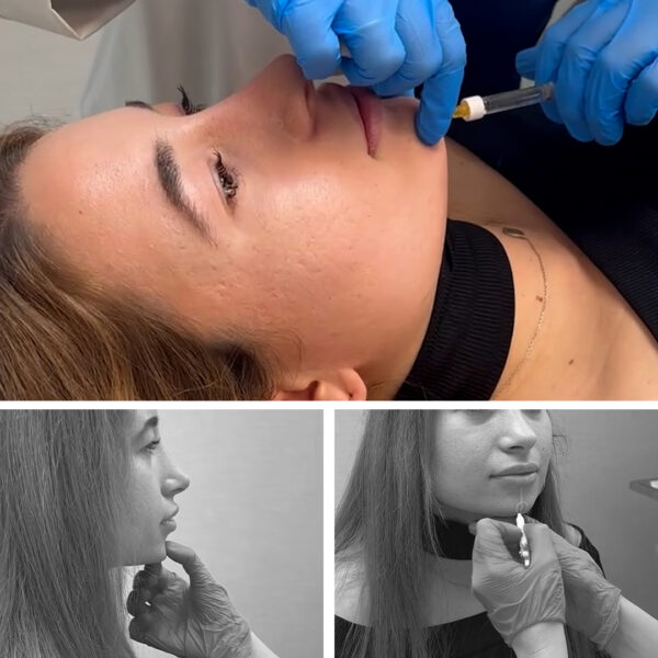 proyeccion-menton-clinicas-diego-de-leon